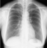 胸部X線写真
